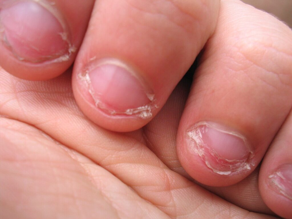 Onychophagy-1024x768 Onicofagia: Entendendo o Hábito de Roer Unhas e os Avanços no Tratamento Psicológico e Comportamental